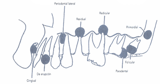 quiste odontogénico glandular