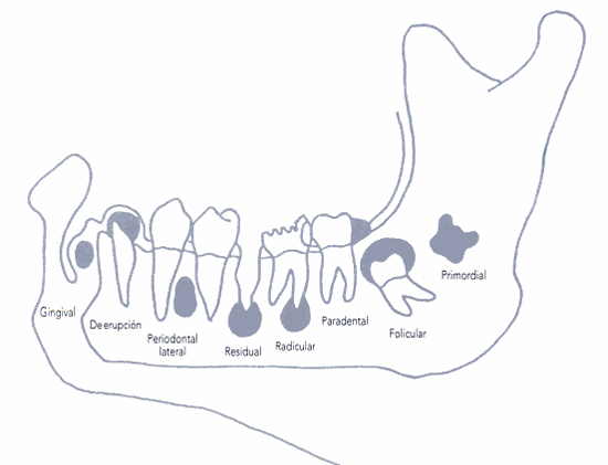 quiste odontogénico glandular